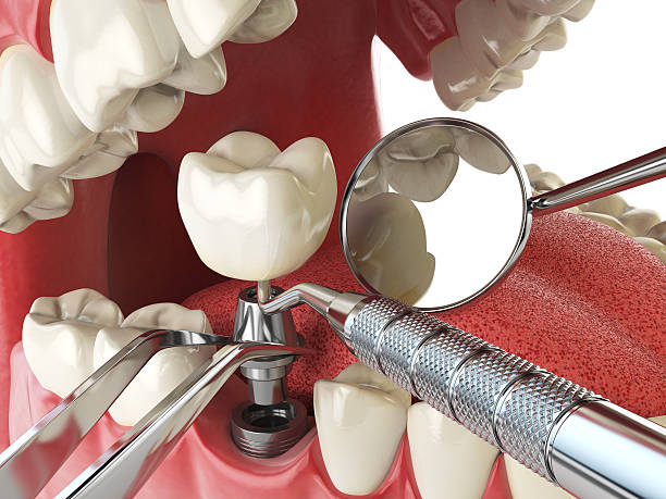 Best Broken or Chipped Tooth Repair in Kettle Falls, WA